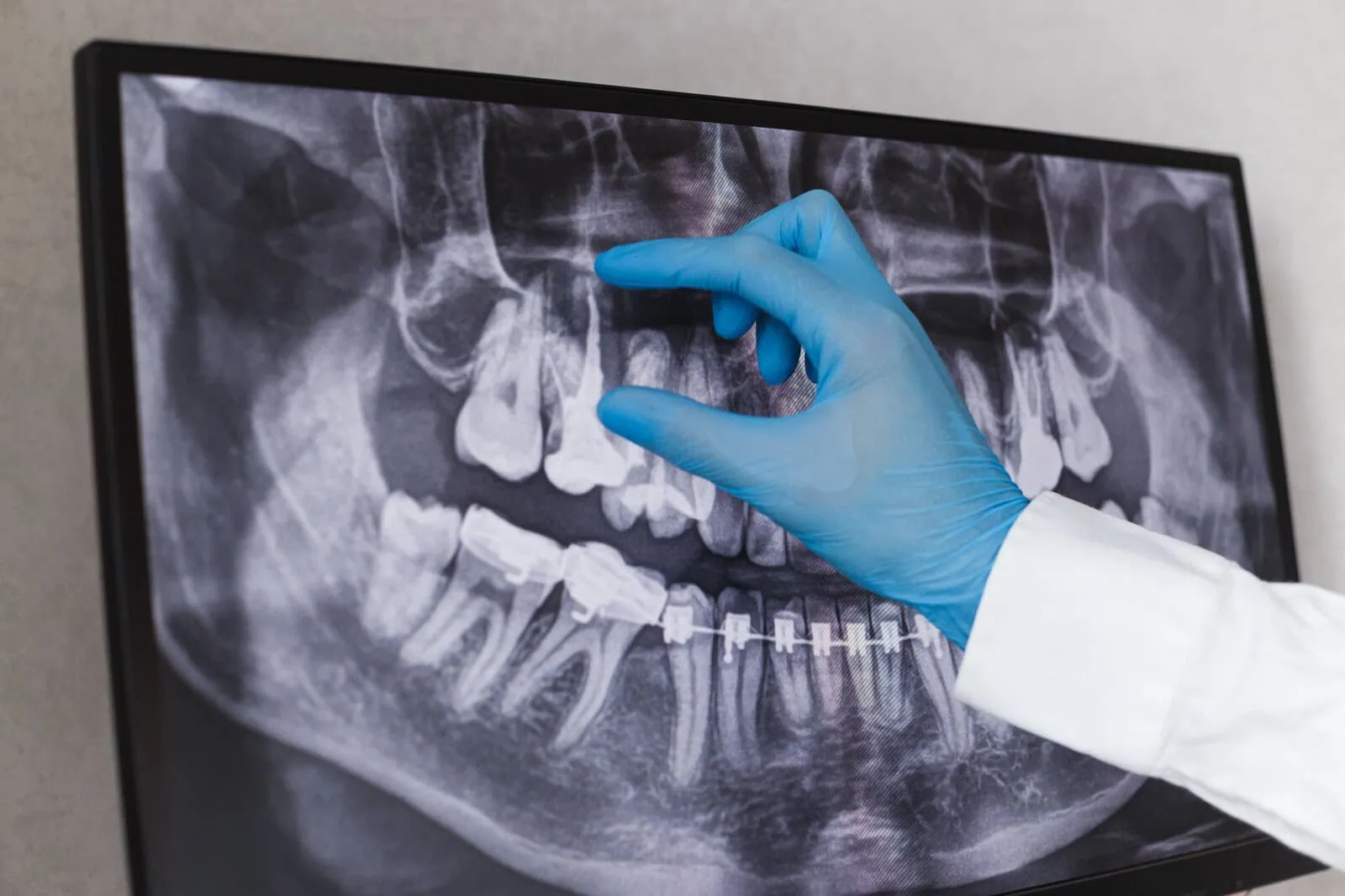 Root canal treatment at Glassell Dental in Orange, CA