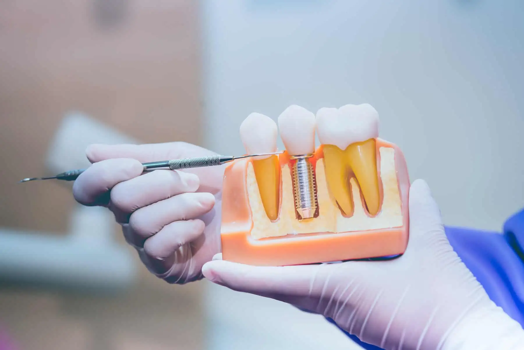 Dental implant model at Glassell Dental in Orange, CA