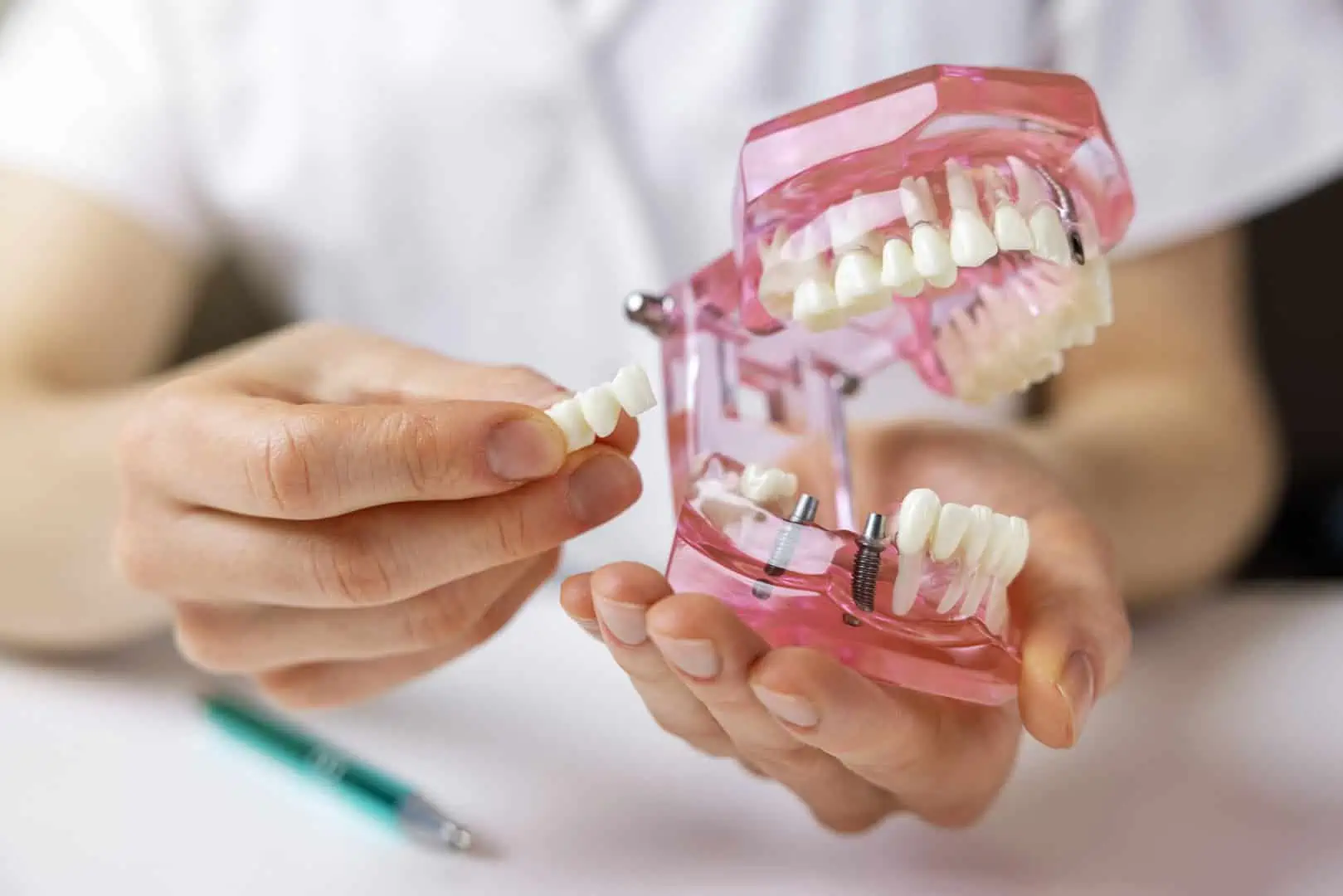 Dental bridge treatment at Glassell Dental in Orange, CA